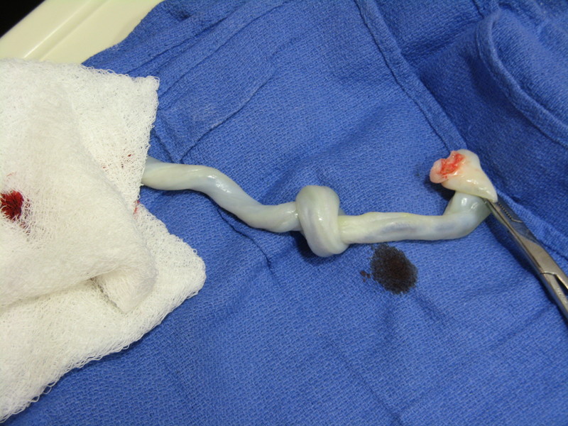 Finny’s umbilical cord